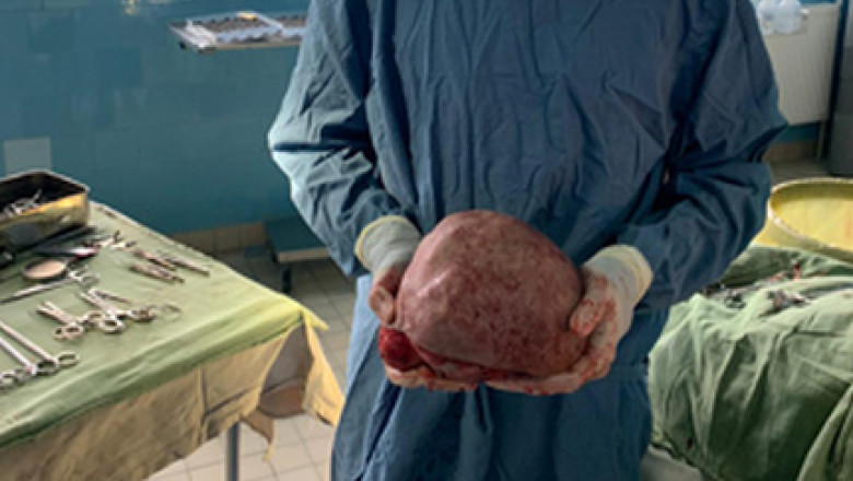 Medicii italieni au extirpat o tumoră 70 de kilograme. În România, în 2004, prof. Lascăr îndepărta una de 72 kg