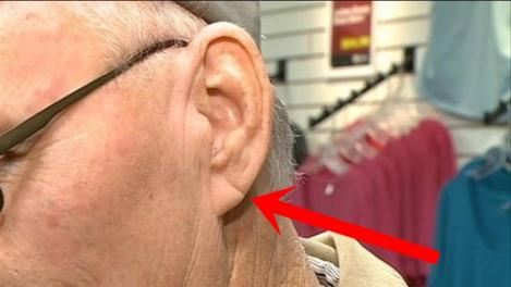 Ear Lobe Sign Predicts Heart Attack